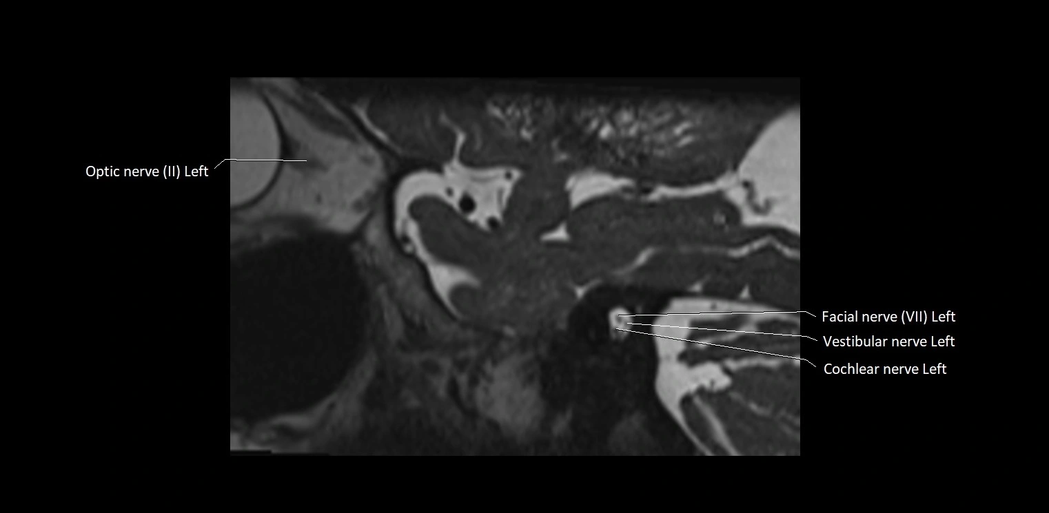 Cranial nerve sagittal anatomy MRI 3T image 11.webp